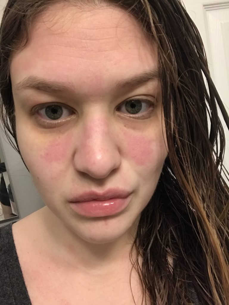 Allergic Reaction III