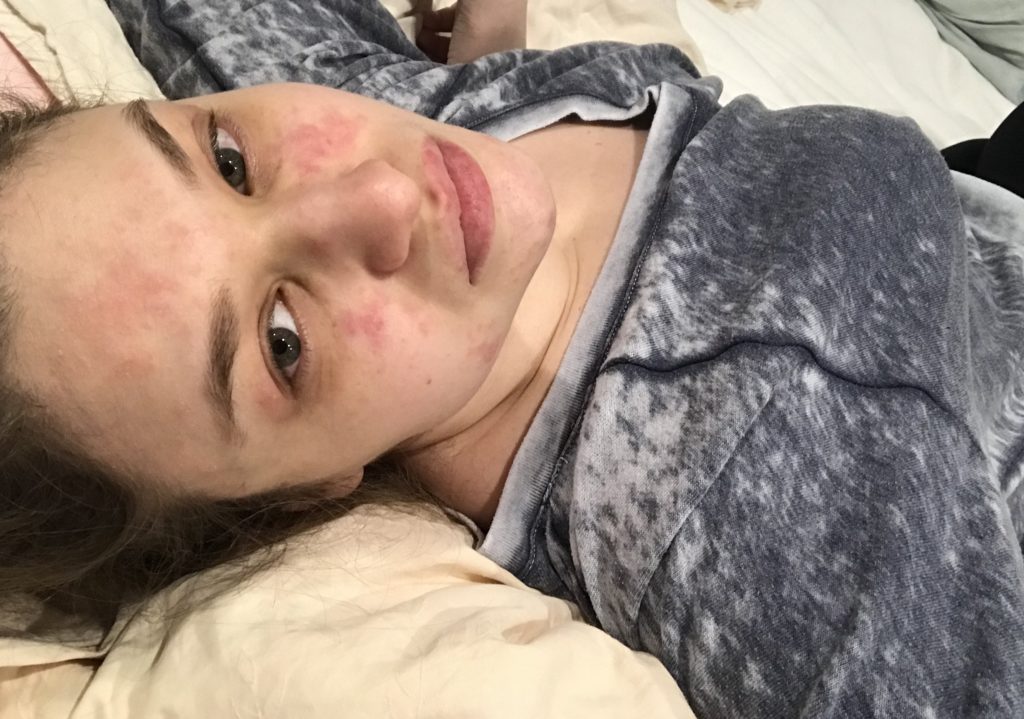 Allergic Reaction II