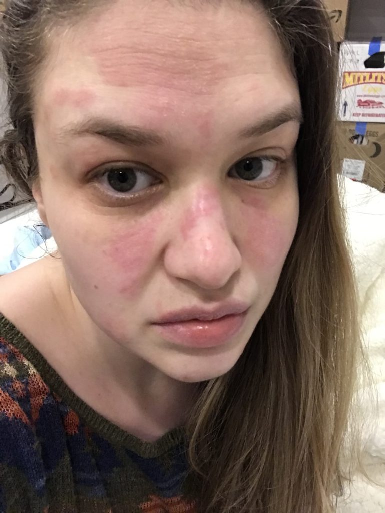 Allergic Reaction I